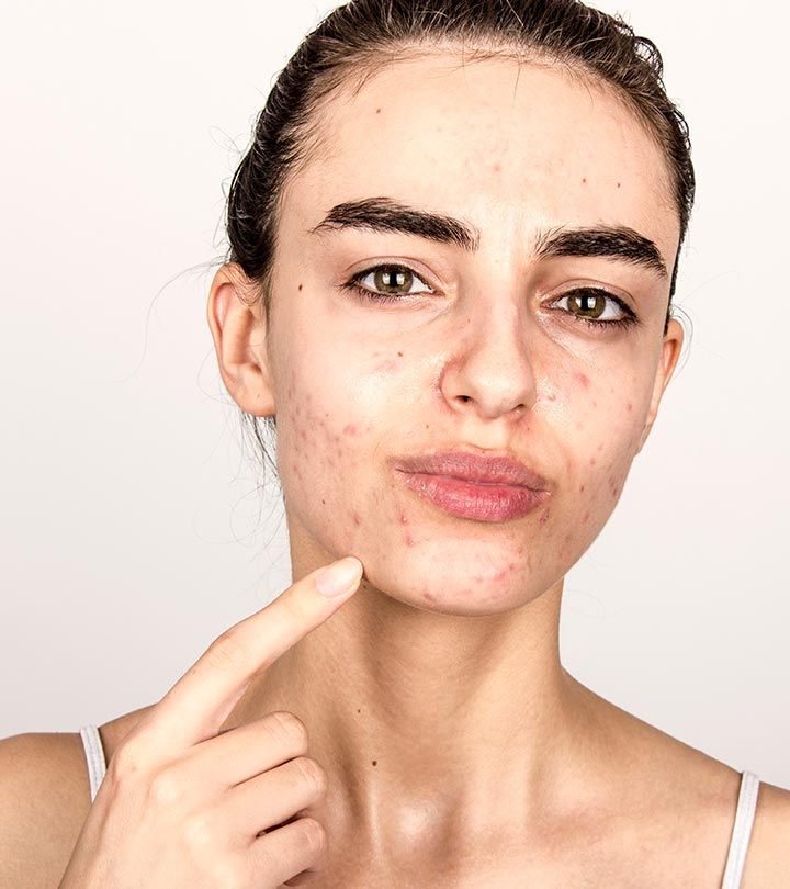 Kistik sivilce rehberi — deri altı kistik akne çeşitleri ve dermatolojik yaklaşımlar